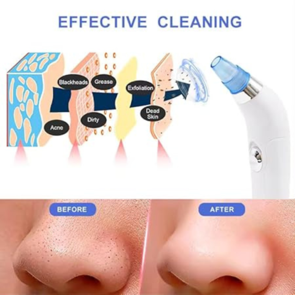 DermaSuction Pore Cleaning Device (Pack of 1)