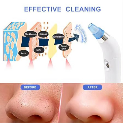 DermaSuction Pore Cleaning Device (Pack of 1)